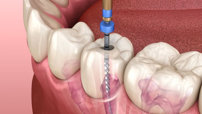 Traitement Endodontique